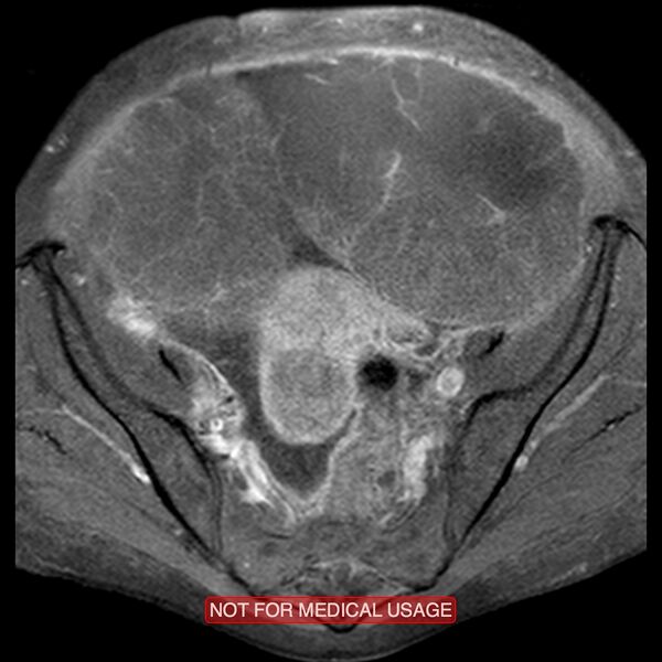 File:Adenocarcinoma of the cervix (Radiopaedia 28373-28615 Axial T1 C+ fat sat 17).jpg