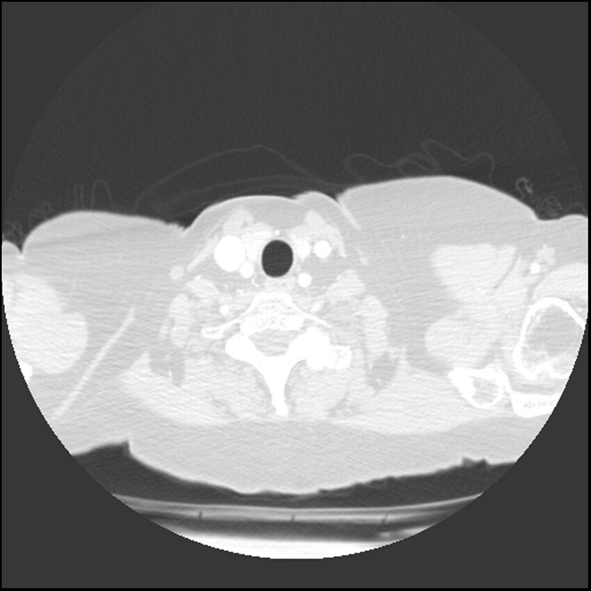 Adenocarcinoma of the lung (Radiopaedia 41015-43755 Axial lung window 1).jpg
