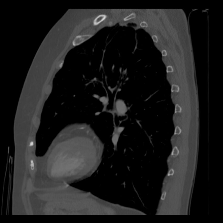 Adenocarcinoma of the lung (Radiopaedia 41015-43755 Sagittal bone window 71).jpg