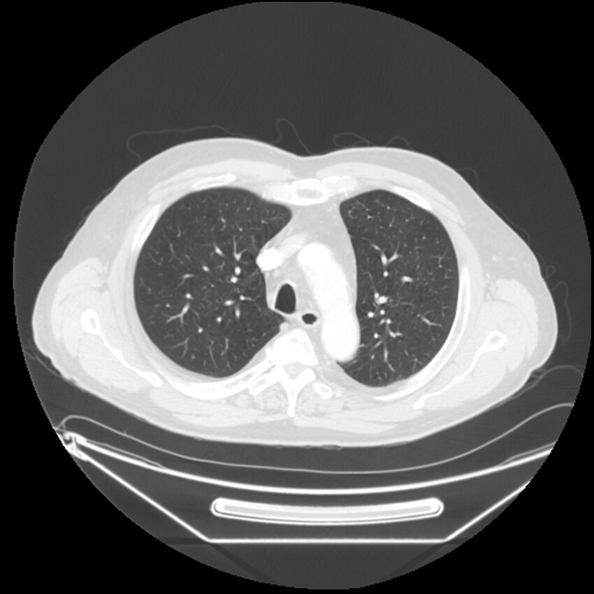 Adenocarcinoma of the lung (Radiopaedia 44876-48759 Axial lung window 22).jpg