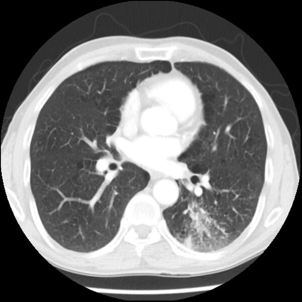 File:Adenocarcinoma of the lung - micropapillary predominant (Radiopaedia 42446-45563 Axial lung window 40).jpg