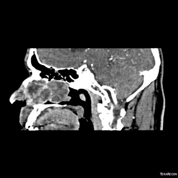 File:Adenoid cystic carcinoma involving paranasal sinus (Radiopaedia 16580-16283 Sagittal C+ arterial phase 5).jpeg