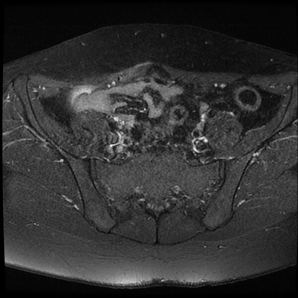 File:Adenomyosis-scar endometriosis (Radiopaedia 65863-75022 Axial T1 C+ fat sat 3).jpg
