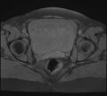 Adenomyosis - ovarian endometriomas (Radiopaedia 67031-76350 Axial T1 fat sat 20).jpg