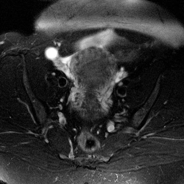 File:Adenomyosis of the uterus (Radiopaedia 9869-10437 Axial T2 2).jpg
