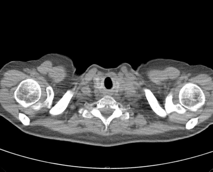 File:Adenosquamous lung carcinoma (Radiopaedia 22035-22030 non-contrast 9).jpg