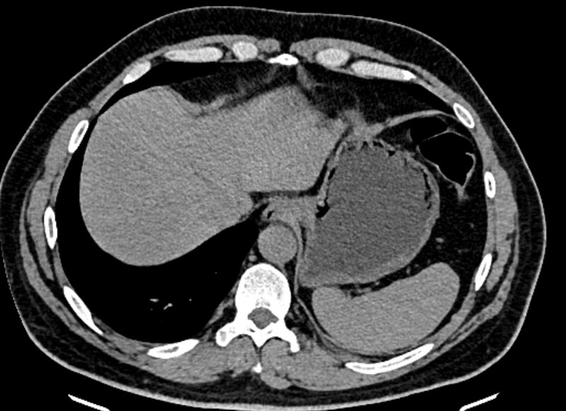 File:Adrenal metastases (Radiopaedia 73082-83791 Axial non-contrast 23).jpg