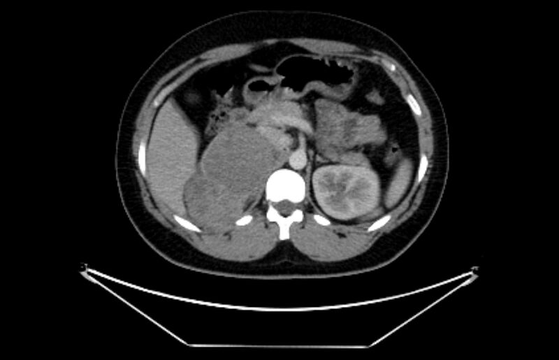 File:Adrenocortical carcinoma (Radiopaedia 80134-93438 Axial C+ portal venous phase 45).jpg