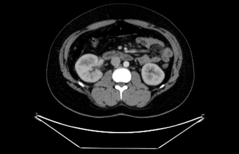File:Adrenocortical carcinoma (Radiopaedia 80134-93438 Axial C+ portal venous phase 61).jpg
