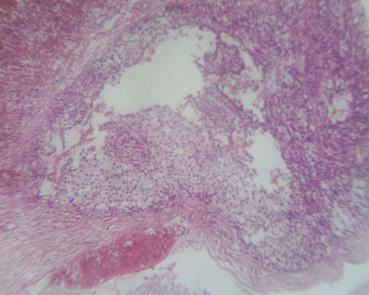 File:Adult granulosa cell tumor of the ovary (Radiopaedia 64991-74394 D 1).jpg