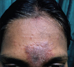 Allergic contact dermatitis to sticker bindi.png