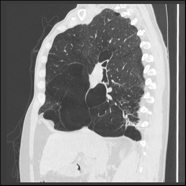 File:Alpha-1-antitrypsin deficiency (Radiopaedia 40993-43722 Sagittal lung window 160).jpg