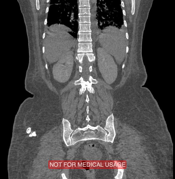 File:Amoebic enterocolitis with liver abscess (Radiopaedia 35100-36609 B 162).jpg