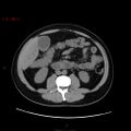 Ampullary carcinoma (Radiopaedia 56396-63056 Axial non-contrast 27).jpg
