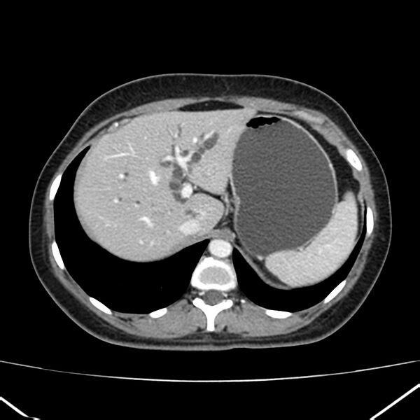 File:Ampullary tumor (Radiopaedia 22787-22816 C 14).jpg