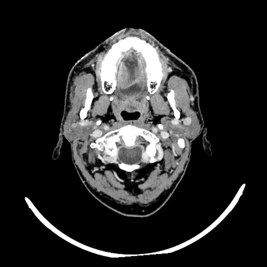 Anaplastic thyroid carcinoma (Radiopaedia 79087-92034 B 103).jpg