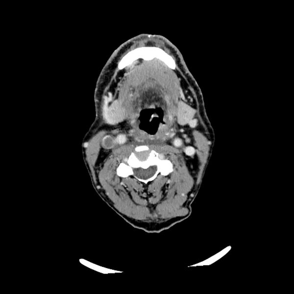 File:Anaplastic thyroid carcinoma (Radiopaedia 79087-92034 B 76).jpg
