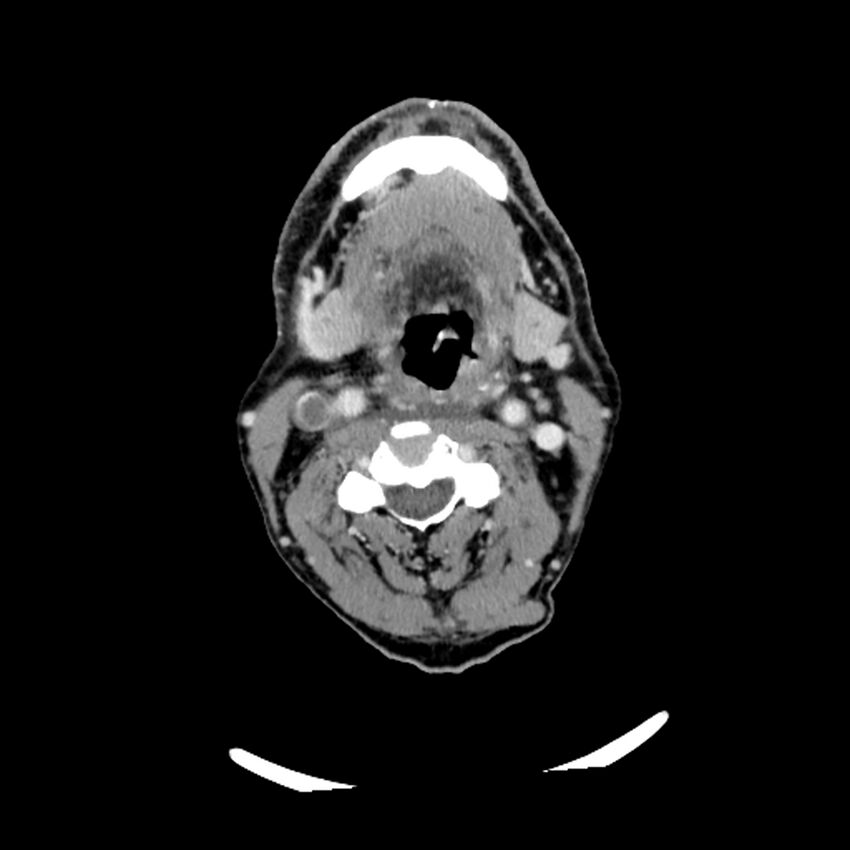 Anaplastic thyroid carcinoma (Radiopaedia 79087-92034 B 76).jpg