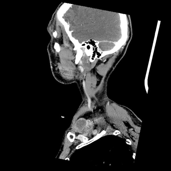 File:Anaplastic thyroid carcinoma (Radiopaedia 79087-92034 C 20).jpg