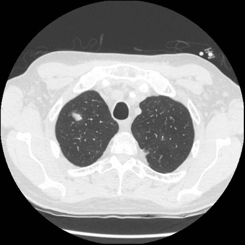 Angioinvasive aspergillosis (Radiopaedia 43957-47466 Axial lung window 13).jpg