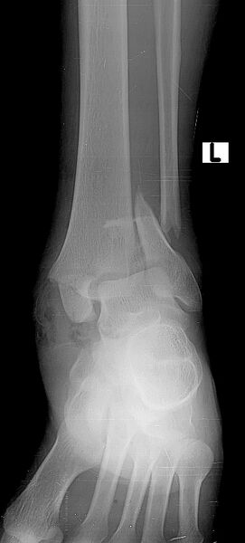 File:Ankle fracture - Weber C (Radiopaedia 69316-79144 Frontal 1).jpg