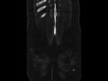 Ankylosing spondylitis (Radiopaedia 44609-48357 Coronal bone window 104).jpg