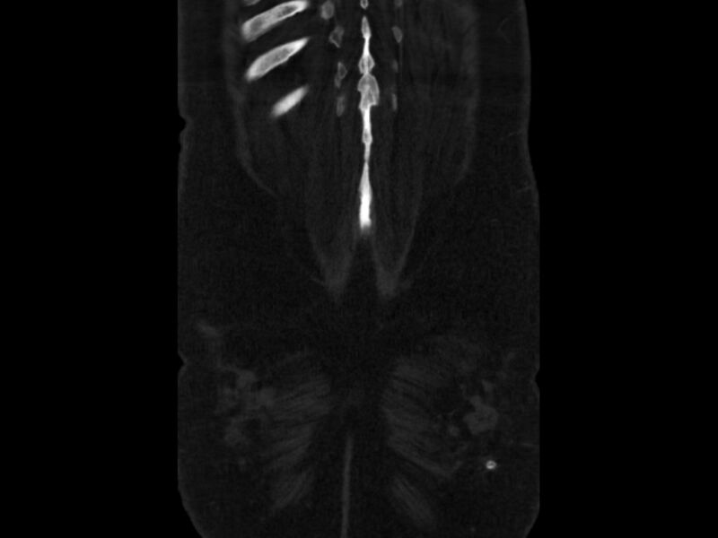 File:Ankylosing spondylitis (Radiopaedia 44609-48357 Coronal bone window 104).jpg