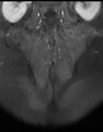 Ankylosing spondylitis - Andersson lesion (Radiopaedia 81878-95838 H 13).jpg
