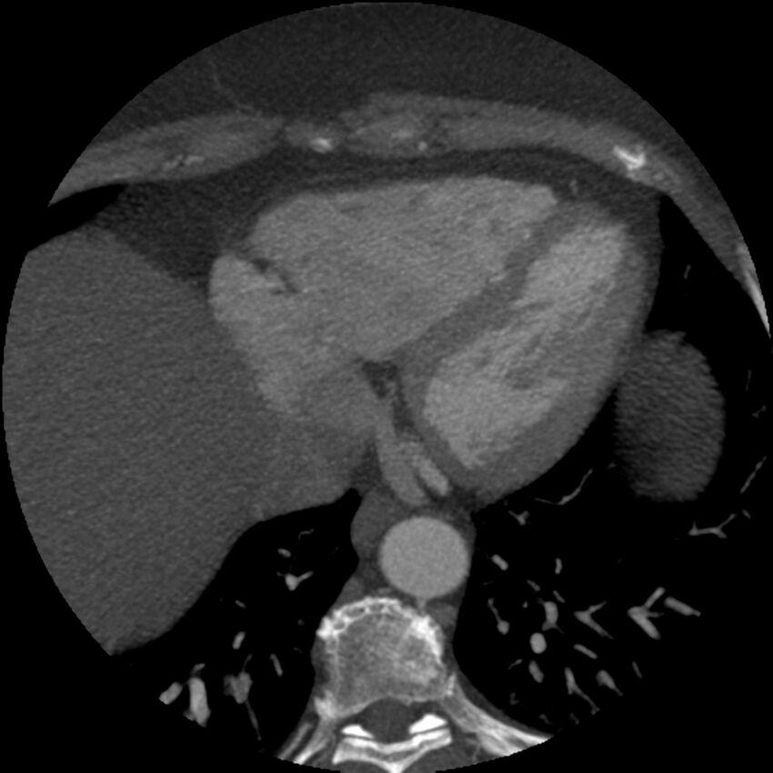 Anomalous origin of left circumflex artery from right coronary sinus (Radiopaedia 72563-83117 A 13).jpg