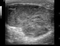 Anterior abdominal wall hematoma (Radiopaedia 11069-11472 D 1).jpg