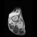 Anterior calcaneal process fracture (Radiopaedia 74654-85611 Coronal T1 3).jpg