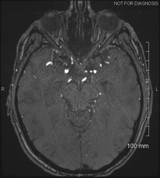 File:Anterior cerebral artery aneurysm (Radiopaedia 80683-94127 Axial MRA 97).jpg