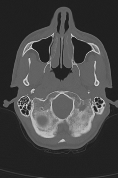 File:Anterior nasal spine fracture (Radiopaedia 46138-50494 Axial bone window 51).png