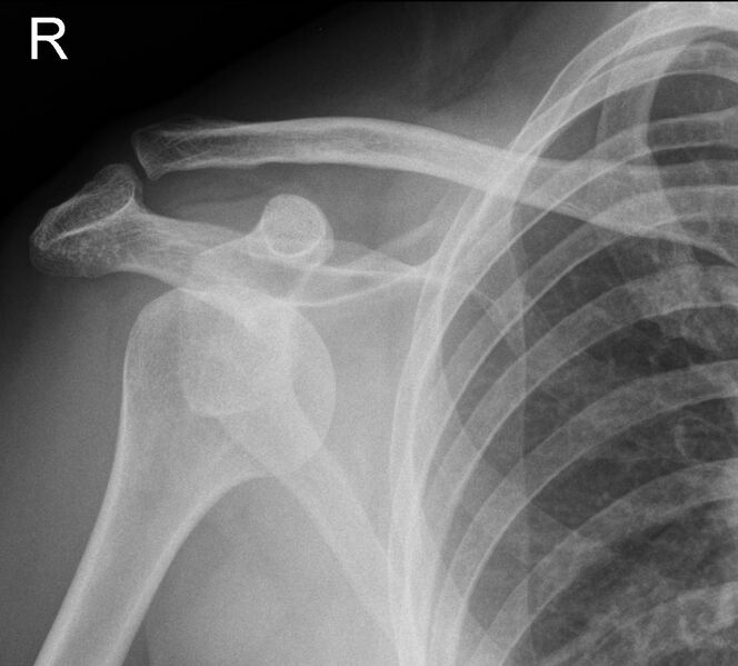 File:Anterior shoulder dislocation (Radiopaedia 7958-8807 Frontal 1).jpg