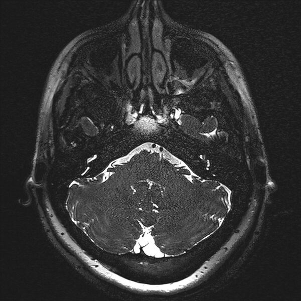 File:Anterior temporal encephalocele (Radiopaedia 82624-96808 Axial T2 high res 3).jpg