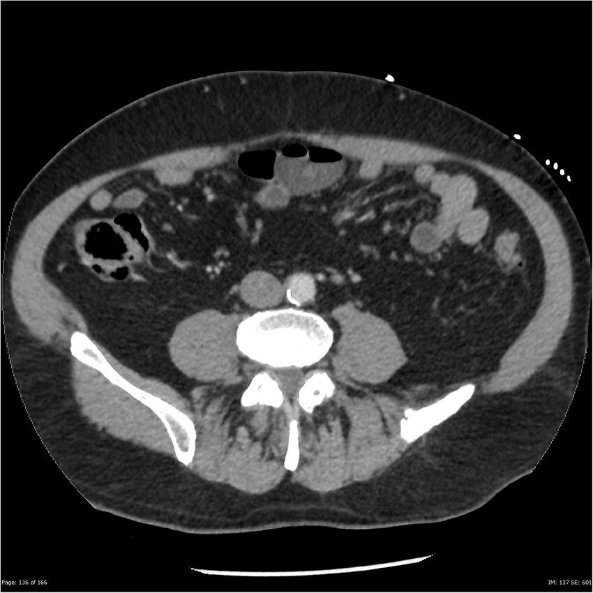 Aortic dissection- Stanford A (Radiopaedia 37759-39664 A 127).jpg