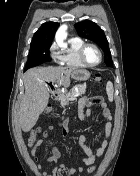 File:Aortic dissection (Radiopaedia 44411-48061 A 3).jpg