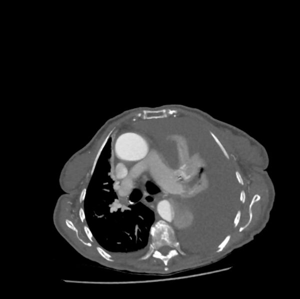 File:Aortic dissection (Radiopaedia 68763-78691 A 20).jpeg