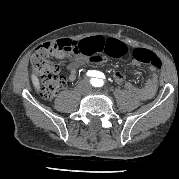 File:Aortic dissection - DeBakey Type I-Stanford A (Radiopaedia 79863-93115 A 64).jpg