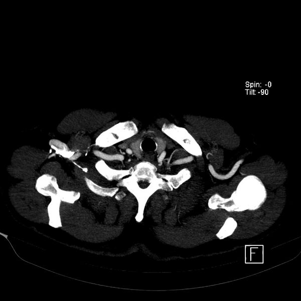 File:Aortic dissection - De Bakey type III - Stanford B (Radiopaedia 21903-21882 B 5).jpg