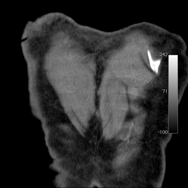 File:Aortic dissection - Stanford type A (Radiopaedia 29247-29659 B 59).jpg
