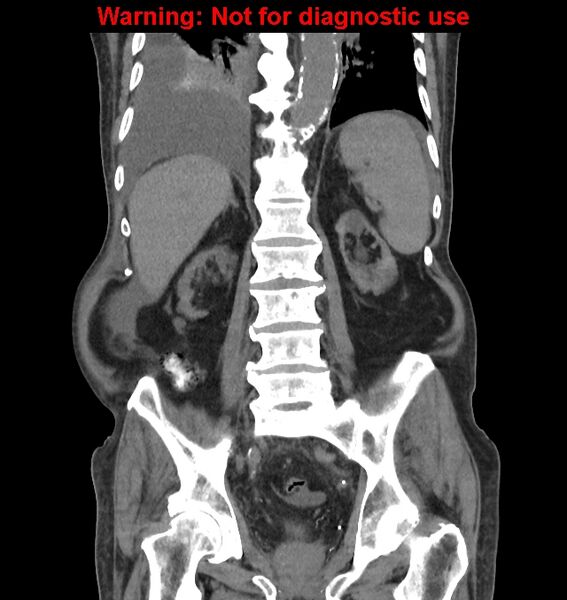 File:Aortic graft infection (Radiopaedia 44979-48907 non-contrast 34).jpg