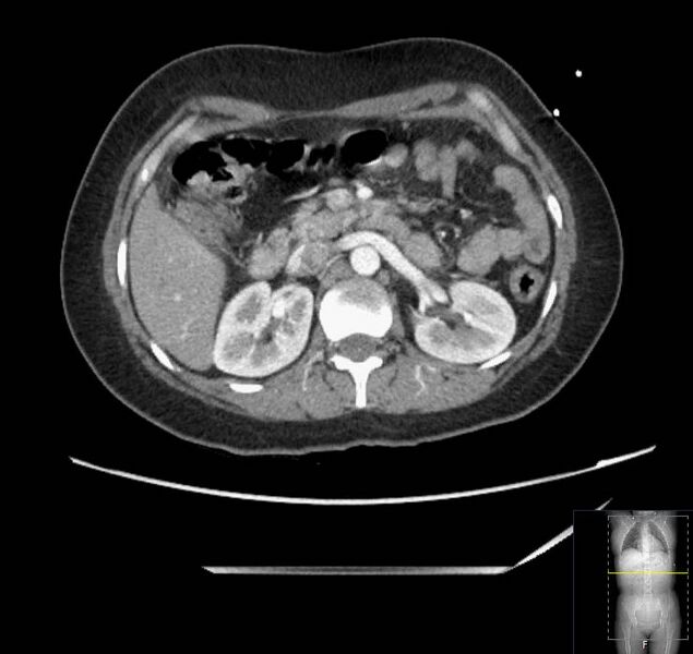 File:Appendicitis (CT angiogram) (Radiopaedia 154713-127660 Axial 125).jpg