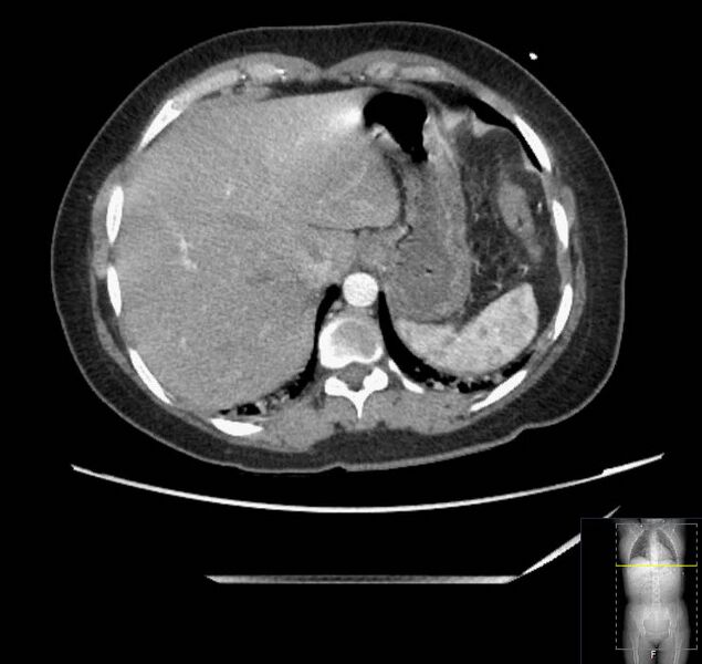 File:Appendicitis (CT angiogram) (Radiopaedia 154713-127660 Axial 165).jpg