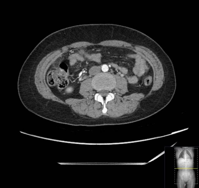 File:Appendicitis (CT angiogram) (Radiopaedia 154713-127660 Axial 71).jpg