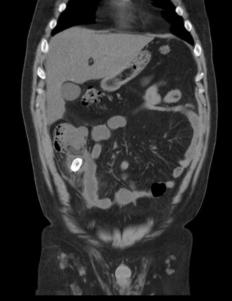 File:Appendicitis and giant appendicolith (Radiopaedia 80251-93588 Coronal non-contrast 12).jpg