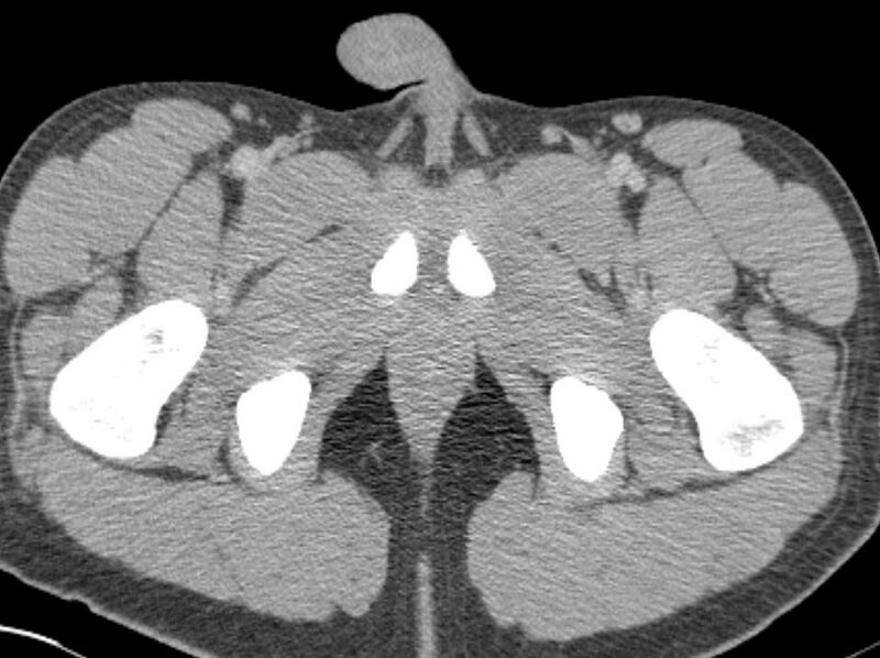 File:Appendicitis and incidental foregut duplication cyst (Radiopaedia 52962-58916 A 112).jpg