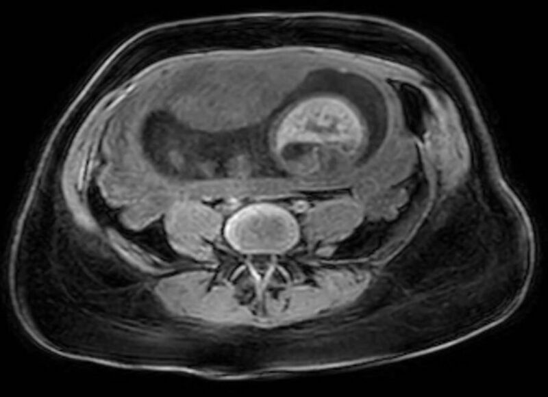 File:Appendicitis in gravida (MRI) (Radiopaedia 89433-106395 Axial DIXON 93).jpg