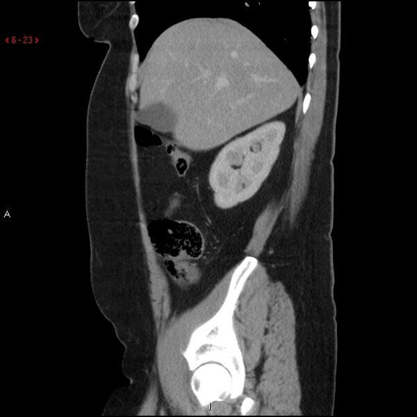File:Appendicitis with microperforation- promontoric type (Radiopaedia 27268-27442 A 8).jpg