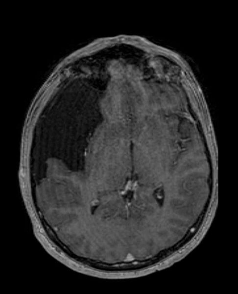 File:Arachnoid cyst- extremely large (Radiopaedia 68741-78451 Axial T1 C+ 40).jpg